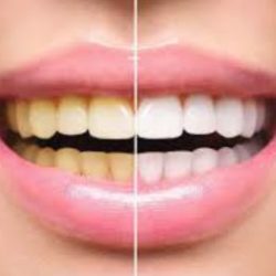 tanden bleken tanden bleken